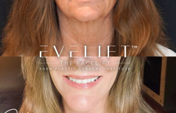 Eden Plastic Surgery Institute female patient's face before and after Eve lift procedure.