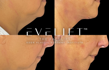 female patient before and after EVELift®