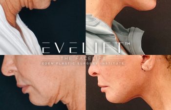 Eden Plastic Surgery Institute female patient's face before and after Eve lift procedure.