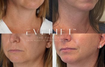 female patient before and after EVELift® + volume restoration with fat