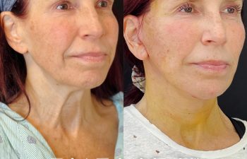 female patient before and after EVELift® + volume restoration with fat