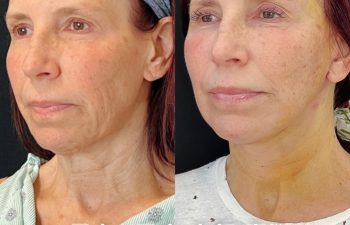 female patient before and after EVELift® + volume restoration with fat