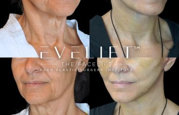 Eden Plastic Surgery Institute female patient's face before and after Eve lift procedure.