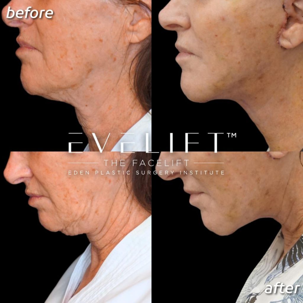 female patient before and after EVE Lift™️ + volume restoration with fat