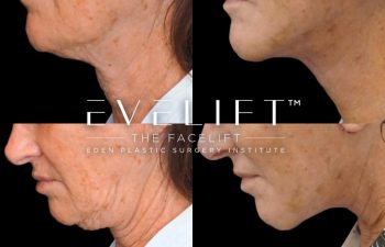 female patient before and after EVELift® + volume restoration with fat