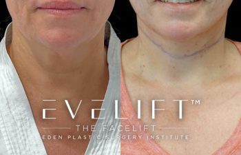 Eden Plastic Surgery Institute female patient's face before and after Eve lift procedure.