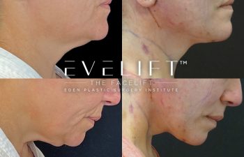 Eden Plastic Surgery Institute female patient's face before and after Eve lift procedure.