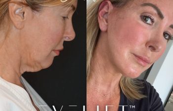 Eden Plastic Surgery Institute female patient's face before and after Eve lift procedure.