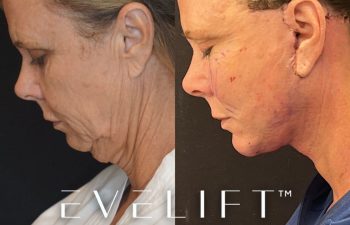female patient before and after EVELift®