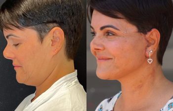 female patient before and after EVELift®