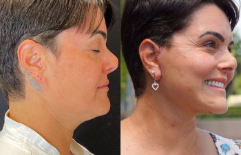 female patient before and after EVELift®