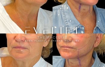 female patient before and after EVELift® + volume restoration with fat