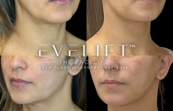 female patient before and after EVELift®