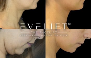female patient before and after EVELift®