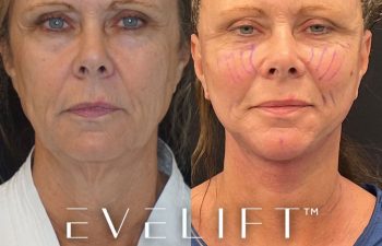 female patient before and after EVELift®