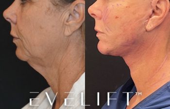 female patient before and after EVELift®