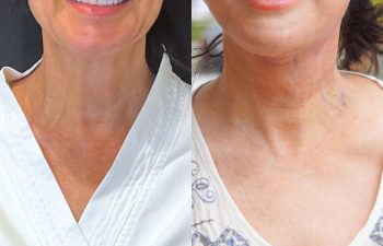 female patient before and after EVELift®