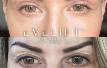 female patient before and after EVELift® + volume restoration with fat