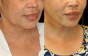 female patient before and after EVELift®