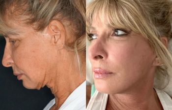 female patient before and after EVELift® + volume restoration with fat