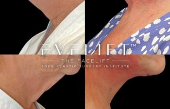 female patient before and after EVELift®