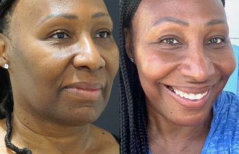 female patient before and after EVELift®