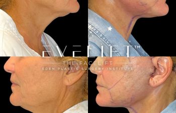 female patient before and after EVELift® + volume restoration with fat