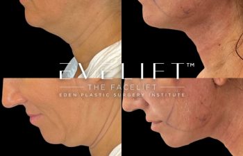 female patient before and after EVELift®