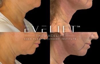 female patient before and after EVELift®