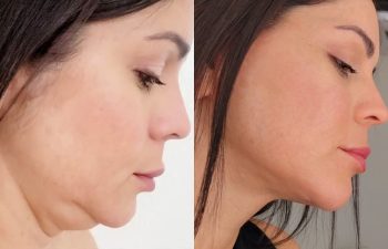 female patient before and after EVELift® + volume restoration with fat