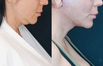 female patient before and after EVELift® + volume restoration with fat