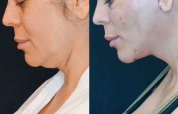 female patient before and after EVELift® + volume restoration with fat