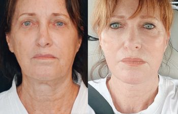 female patient before and after EVELift®
