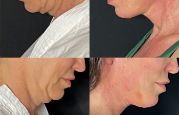 female patient before and after EVELift®