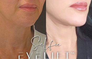 female patient before and after EVELift®
