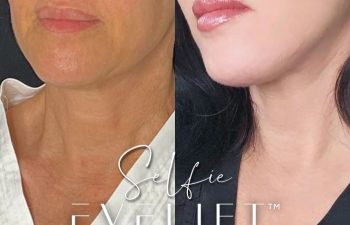 female patient before and after EVELift®