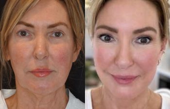female patient before and after EVELift®
