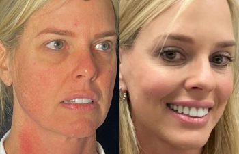 female patient before and after EVELift®