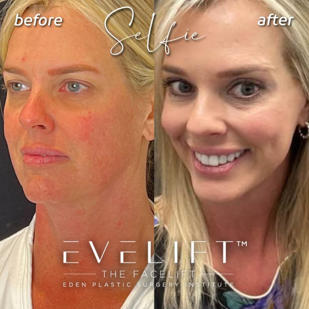 female patient before and after EVE Lift™️