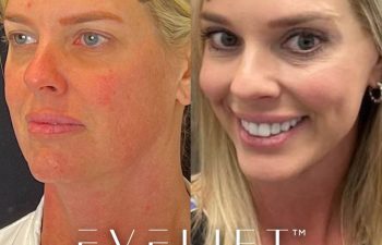 female patient before and after EVELift®