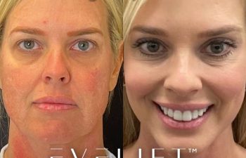female patient before and after EVELift®