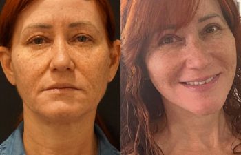 female patient before and after EVELift®
