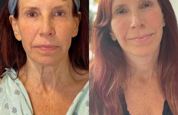 female patient before and after EVELift®