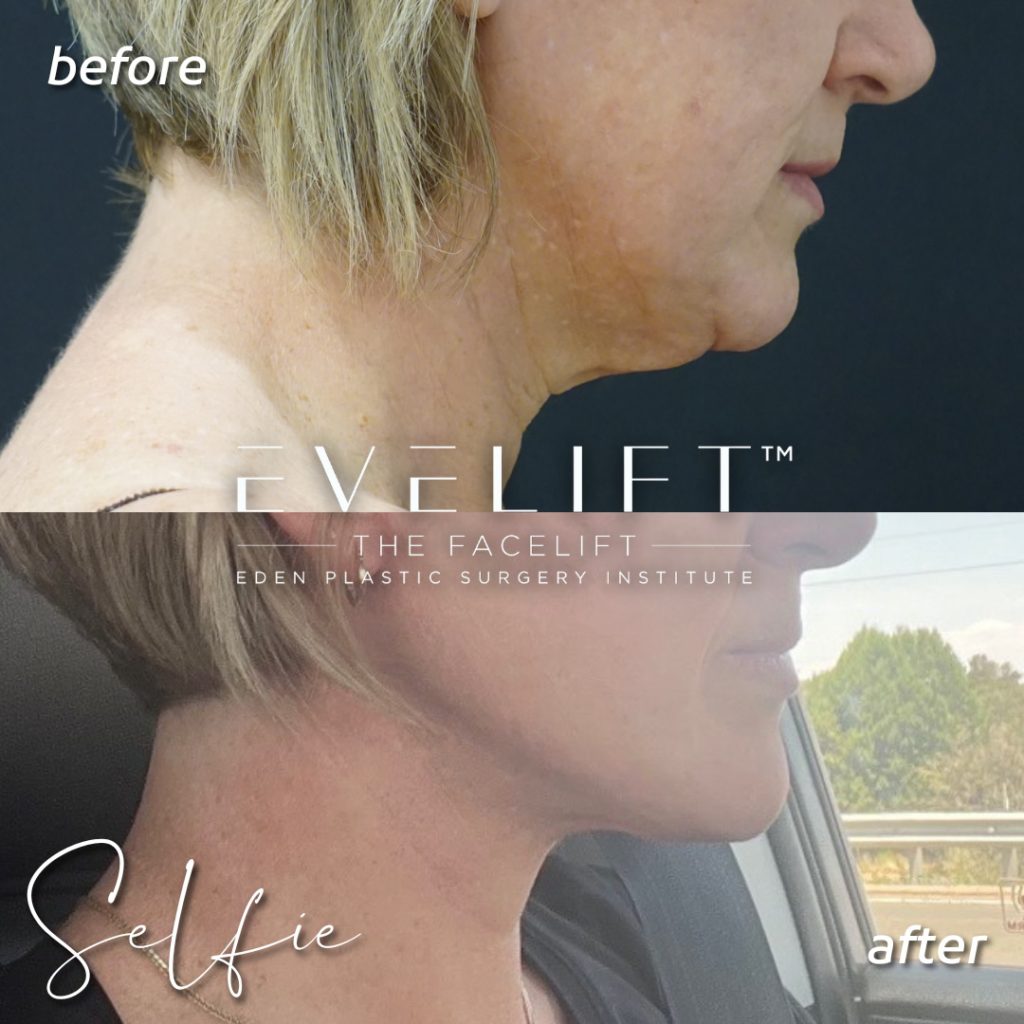 51-years-young, flew all the way from Arizona for her EVE Lift™️ + volume restoration with fat.