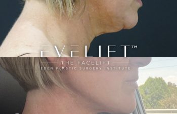 51-years-young, flew all the way from Arizona for her EVELift® + volume restoration with fat.