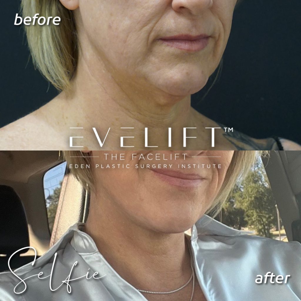 51-years-young, flew all the way from Arizona for her EVE Lift™️ + volume restoration with fat.
