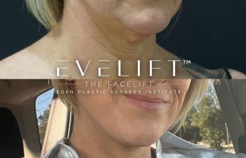 51-years-young, flew all the way from Arizona for her EVELift® + volume restoration with fat.