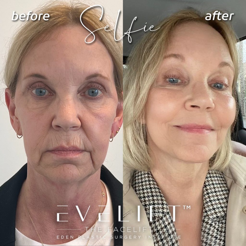 66-years-young, flew all the way from Boston, Massachusetts for her EVE Lift™️ + volume restoration with fat in May 2022. Thrilled with her results, she returned a year later for more volume restoration + smart peel laser resurfacing.