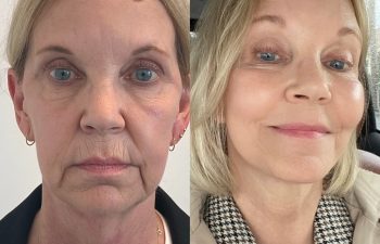 66-years-young, flew all the way from Boston, Massachusetts for her EVELift® + volume restoration with fat in May 2022. Thrilled with her results, she returned a year later for more volume restoration + smart peel laser resurfacing.