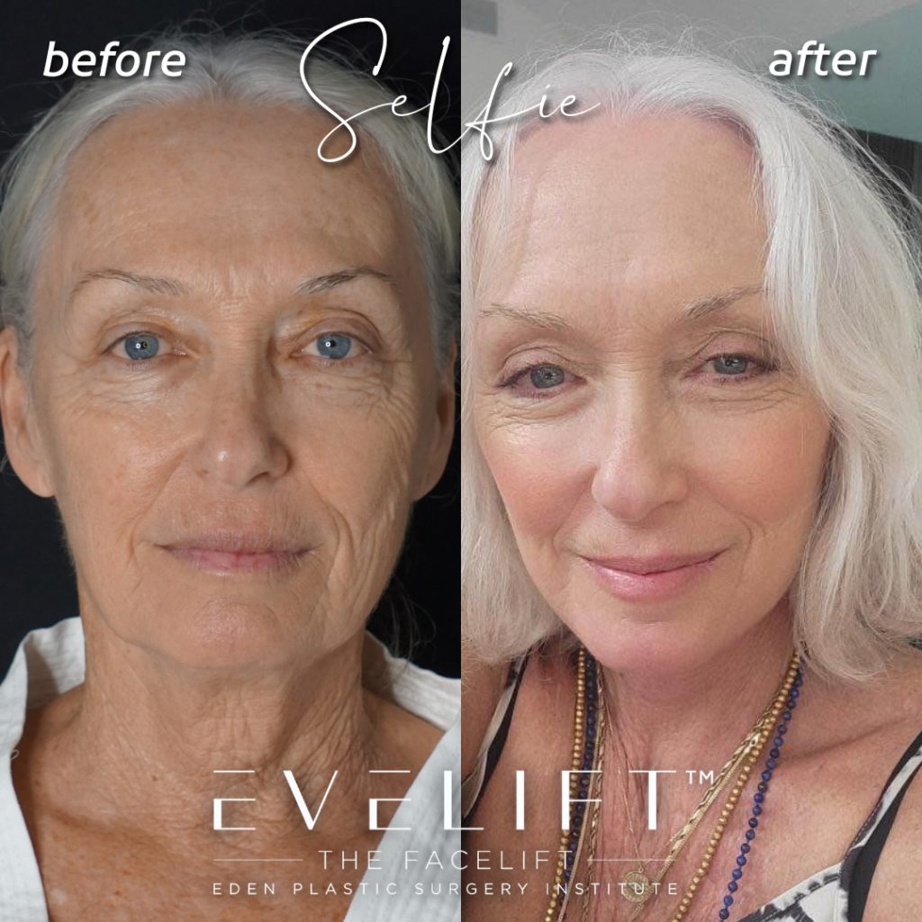 64-years-young, had never had a facial rejuvenation procedure before. She did her research and talked to plastic surgeons all over before she fell in love with our natural, refreshing results. Dawn opted for our signature EVE Lift™️ + volume restoration with fat.